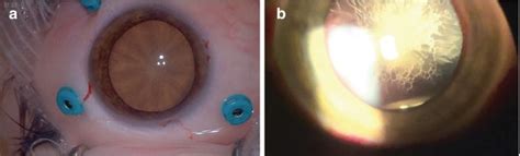 cataract surgery huddersfield|Eye, Vitreoretinal and Cataract Surgeon .